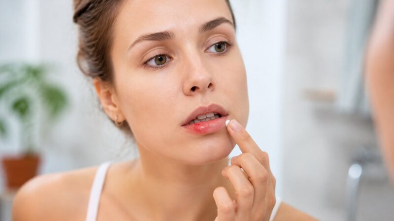 Como Secar Herpes Labial em Uma Noite: Métodos e Cuidados Profissionais